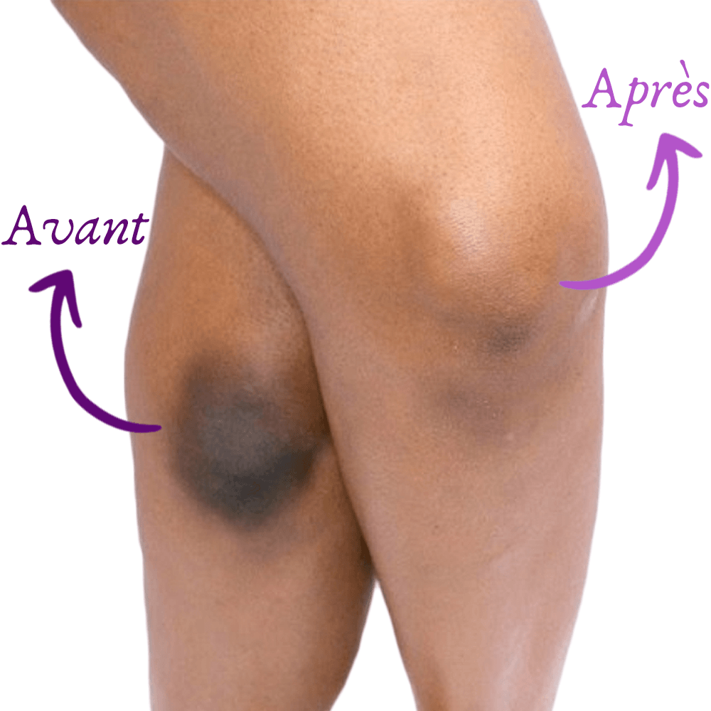 Savon antitache Soapy® : Éliminez les taches noires & impuretés de votre corps