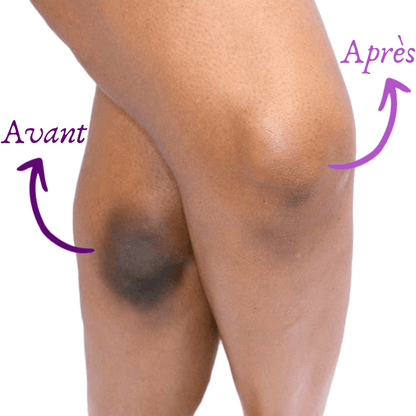 Savon antitache Soapy® : Éliminez les taches noires & impuretés de votre corps