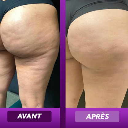 Ventouse Anti-Cellulite Électrique SkinBot®